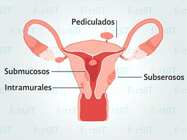 miomatosis-uterina-destacada.jpg