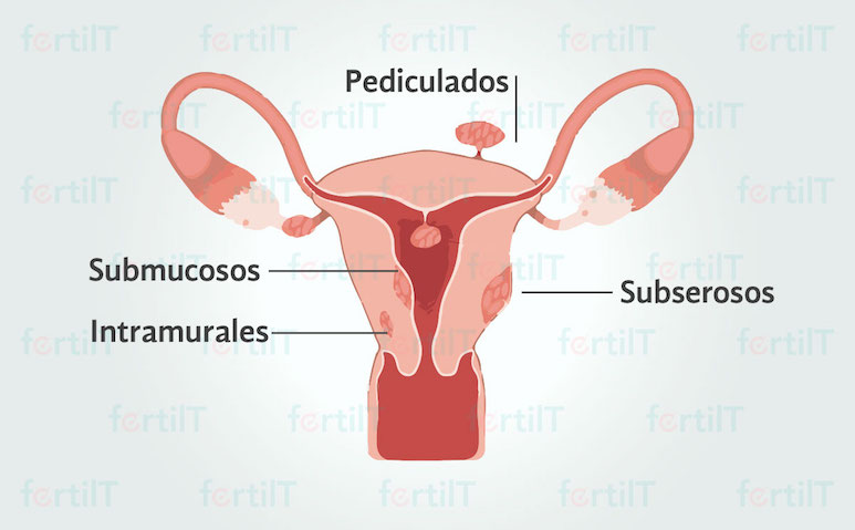 Ilustración de un útero con clasificación de miomatosis uterina