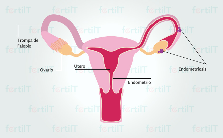 ilustración de un útero con adherencias de endometriosis