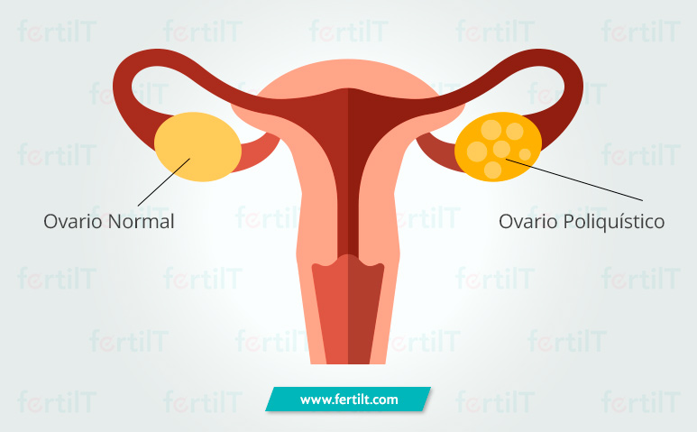 ilustración comparativa de un ovario normal y un ovario con síndrome de ovarios poliquísticos