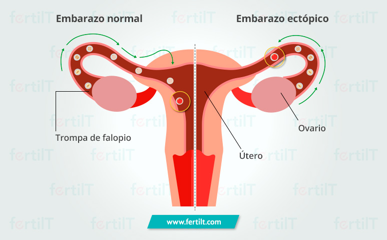 Comparativo entre un embarazo ectópico y un embarazo normal