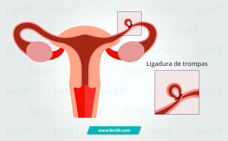 representación de una salpingoclasia