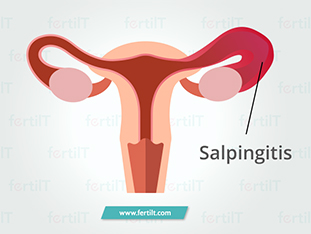 salpingitis.jpg