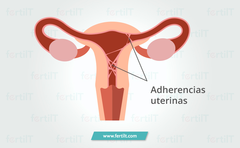 Imagen representativa de un útero con adherencias uterinas