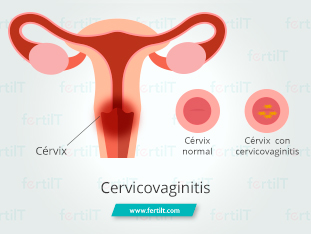 cervicovaginitis-que-es.jpg