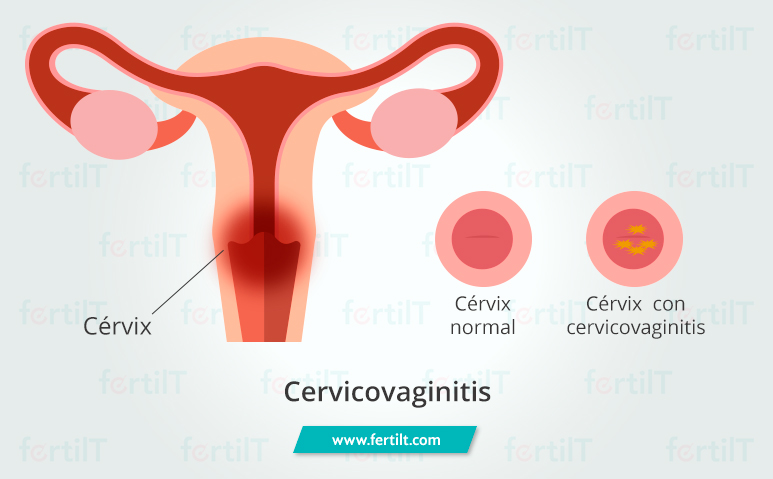 Ilustración del aparato reproductor femenino señalando el cérvix