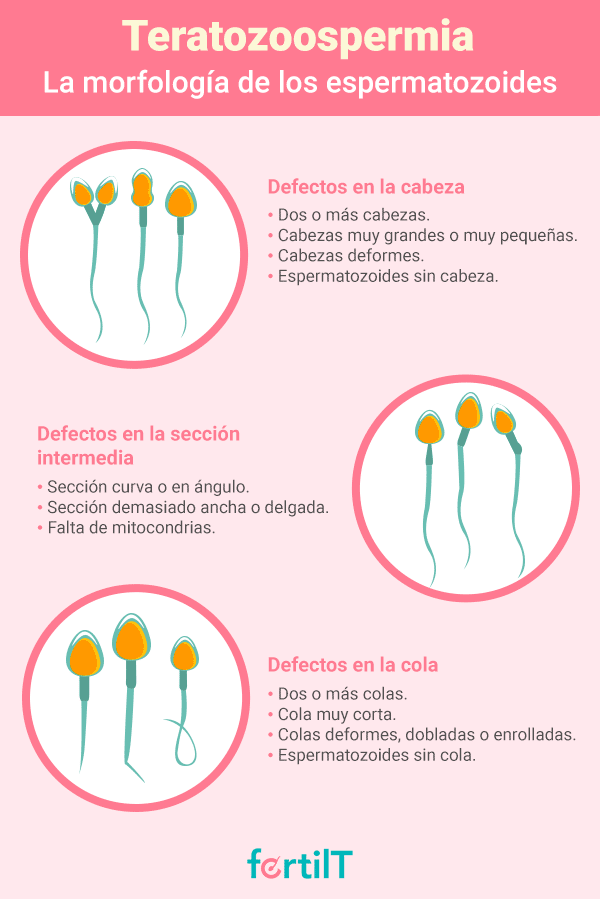 infografia de la morfologia de los espermatozoides con teratozoospermia