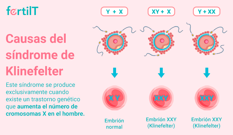 Infografía Causas del Síndrome de Klinefelter 