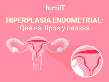 Portada de artículo Hiperplasia endometrial: Qué es, tipos y causas