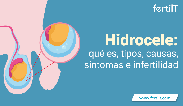 Portada de artículo Hidrocele, qué es, tipos, causas, síntomas e infertilidad