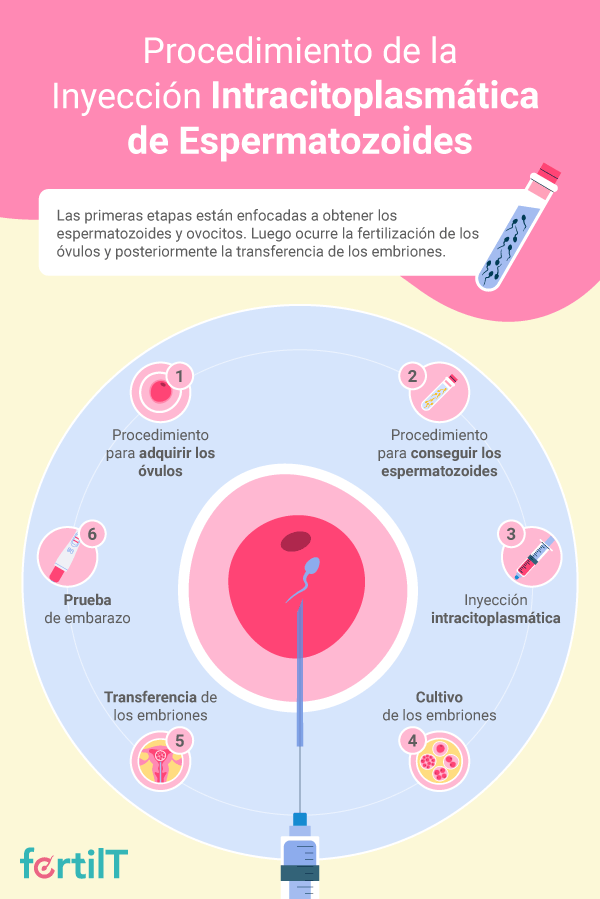 Infografía con los pasos del procedimiento de inyección intracitoplasmática de espermatozoides
