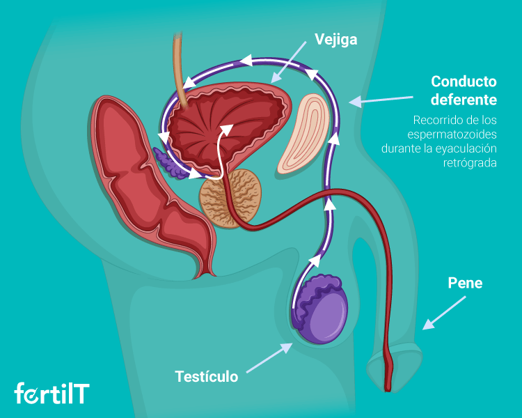 Infografía con el recorrido que hacen los espermatozoides en la eyaculación retrógrada