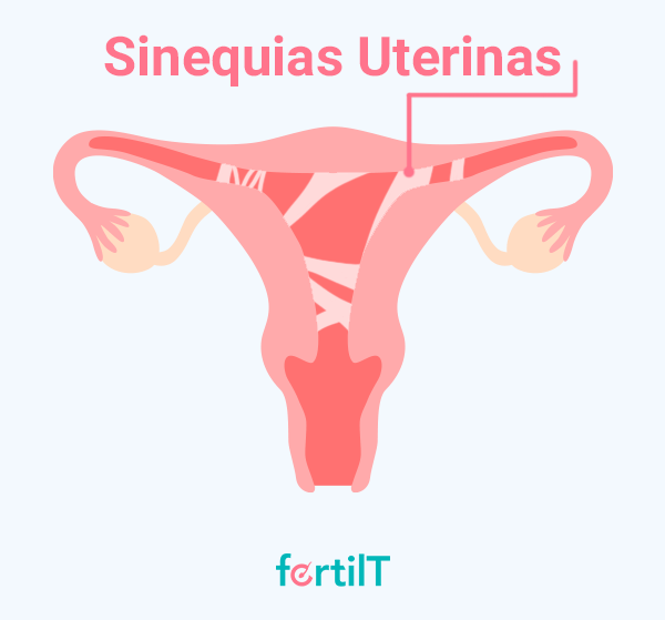 Representación de sinequias uterinas con vectores