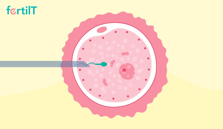 Técnica de inyectar el espermatozoide en el óvulo
