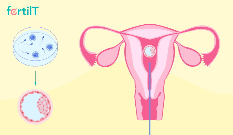 Referencia gráfica de una fertilización in vitro