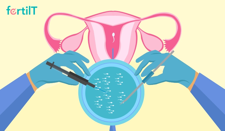 Proceso de elección del espermatozoide