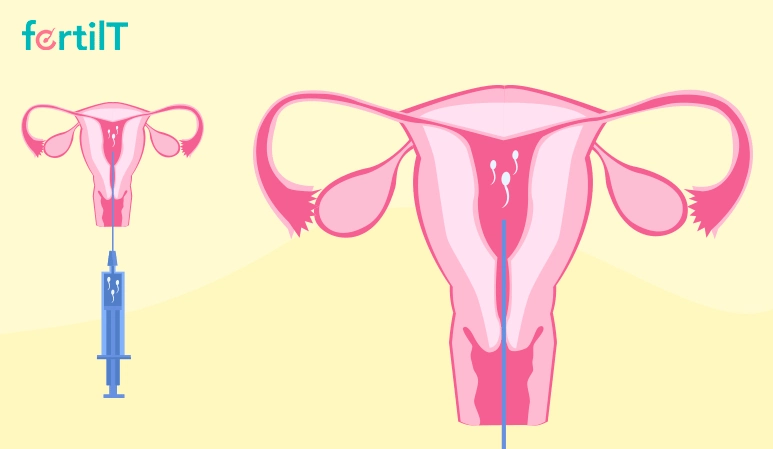Explicación del proceso de inseminación artificial
