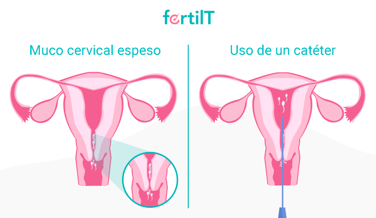 representación de la infertilidad por factor cervical