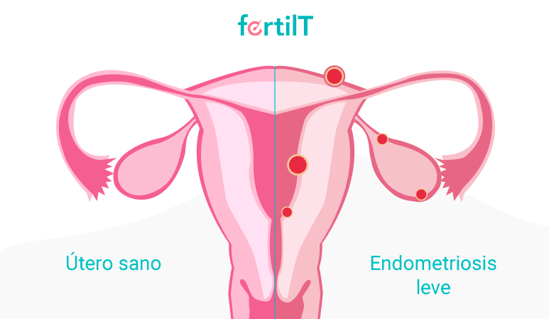 caso de endometriosis leve
