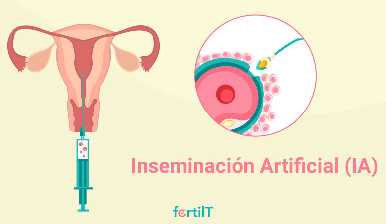Inseminación artificial para convertirte en madre estando soltera